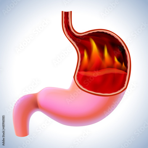 3D illustration of a stomach with flames burning inside is a sign of burning pain, a symptom of gastritis. cut open to see inside For medical, educational, industrial and scientific use