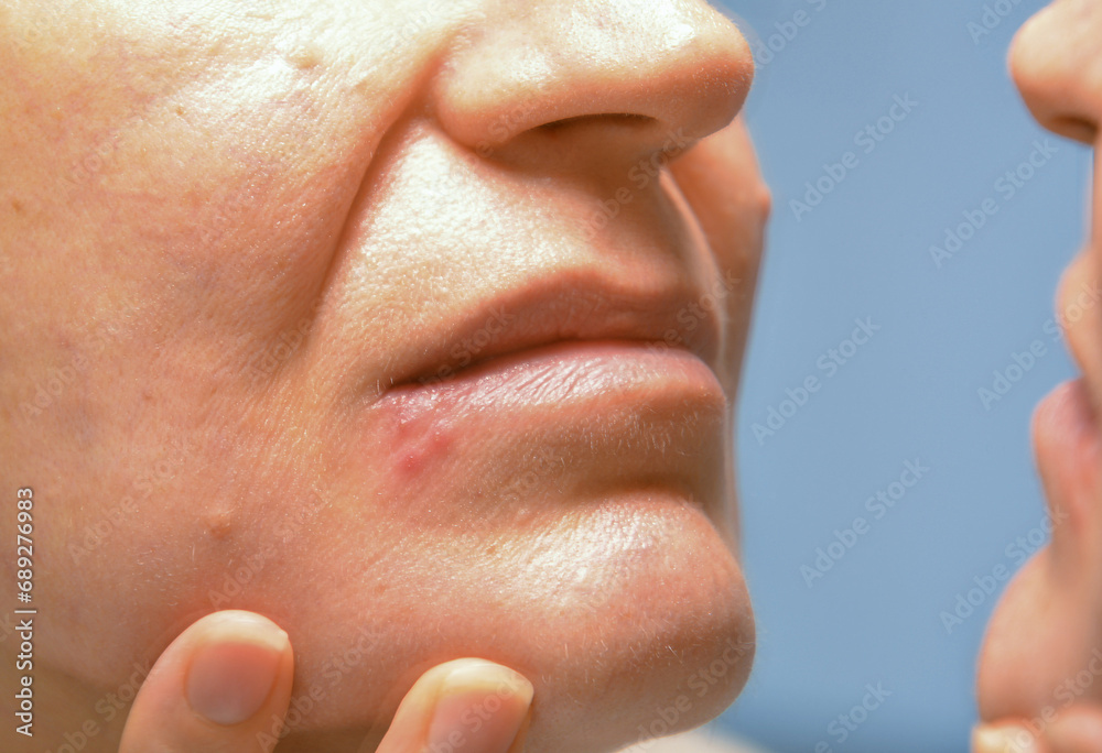 A close-up shot of the face of a 50+ woman looking at herpes on her lip and her facial skin in the mirror. - obrazy, fototapety, plakaty 