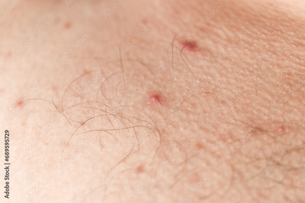 Macro shot of red pimples on a human skin, acne disease, dermatology problem Macro shot of red pimples on a human skin, acne disease, dermatology problem