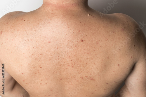Naked man with red pimples on his back, acne skin disease, dermatology problem photo