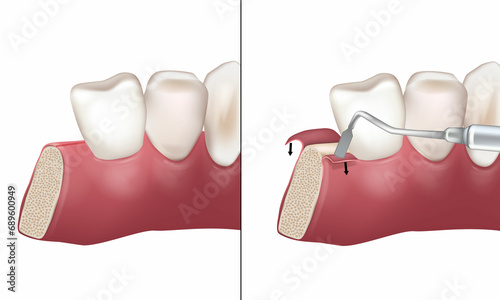 Canvas Print Mid-crestal incision used during implant bed preparation