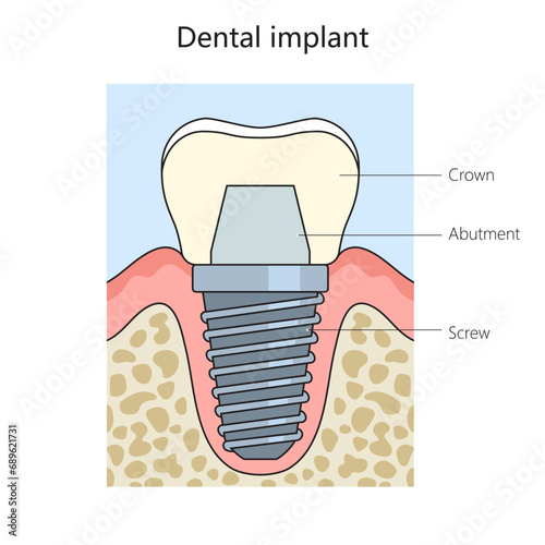 Dental implant structure diagram hand drawn schematic vector illustration. Medical science educational illustration