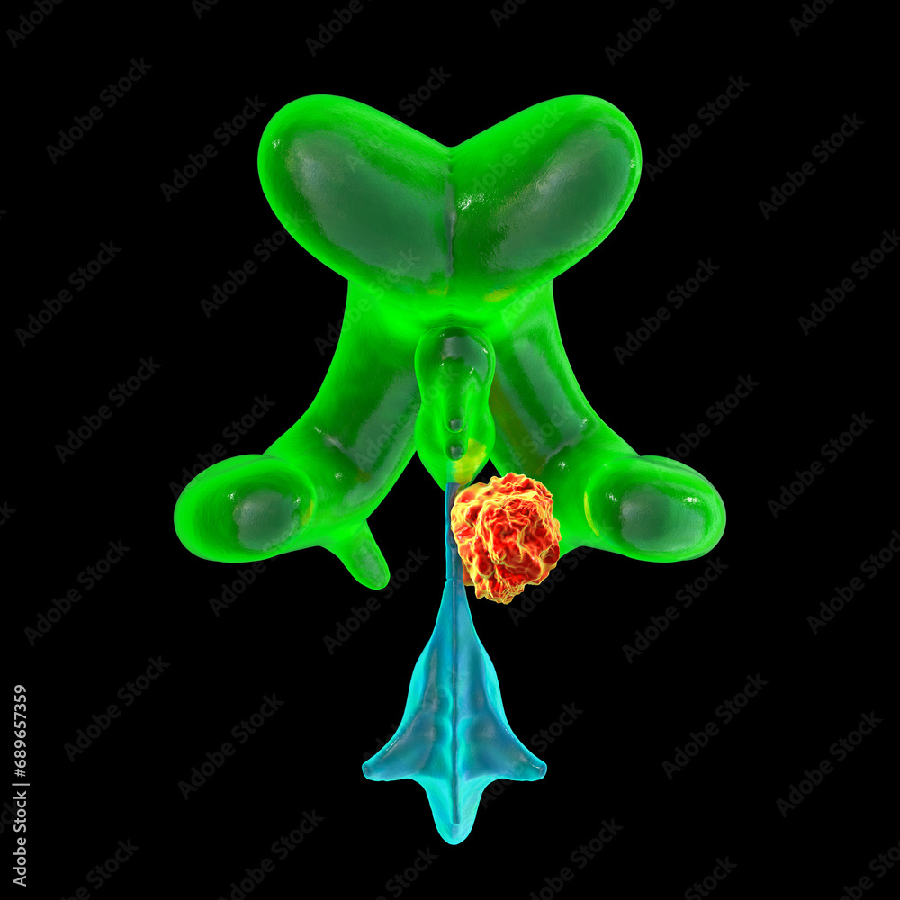 A brain tumor causing hydrocephalus, 3D illustration A brain tumor causing hydrocephalus, 3D illustration