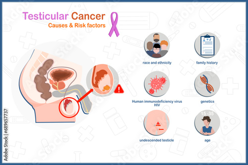 Medical illustration vector concept in flat style of testicular cancer causes and risk factors.family history,age,race and ethnicity,HIV infection,genetic and undescended testicle. photo