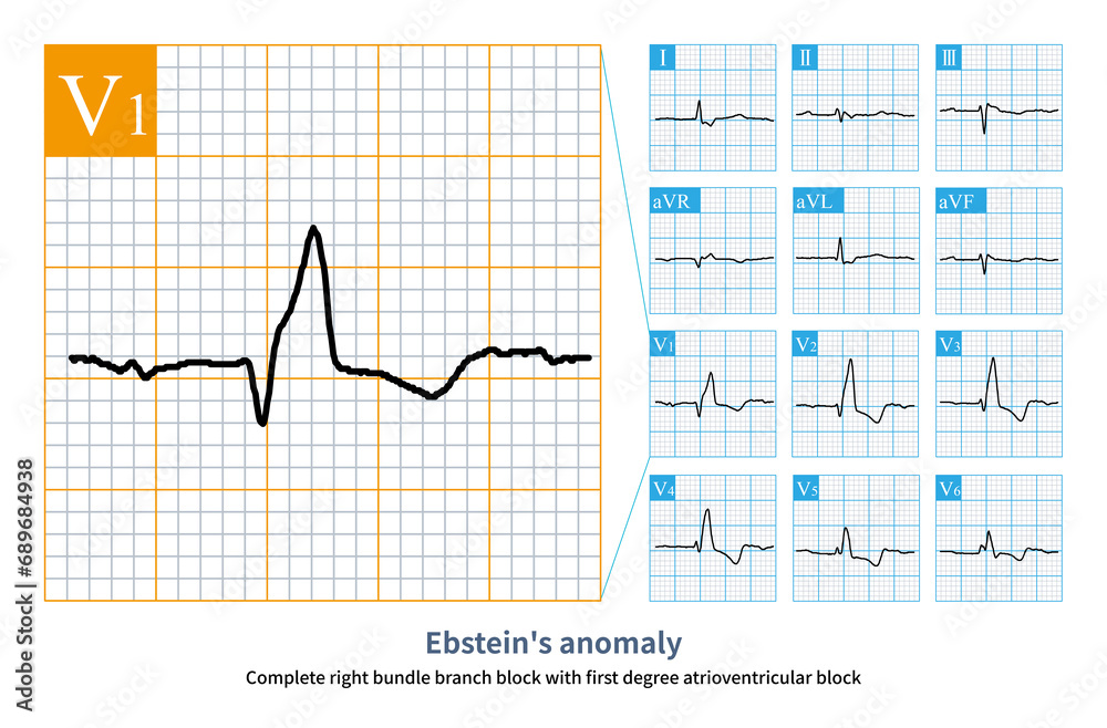 Female, 50 years old, clinically diagnosed as Ebstein's anomaly. Electrocardiogram showed sinus arrhythmia, first degree atrioventricular block and complete right bundle branch block. Female, 50 years old, clinically diagnosed as Ebstein's anomaly. Electrocardiogram showed sinus arrhythmia, first degree atrioventricular block and complete right bundle branch block.