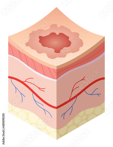 Skincare medical concept. Problems in cross-section of human skin horizontal layers structure. Anatomy illustrative model unhealthy layer of skin