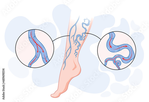 Varicose veins. Blue blood vessel visible through the skin, abnormally swollen leg. Vascular disease diagnostic and treatment. Venous insufficiency medical disease