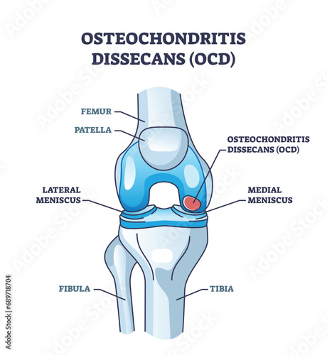 Osteochondritis dissecans or OCD bone and cartilage condition outline diagram. Labeled educational scheme with meniscus and leg bone orthopedics problem from chronic overuse vector illustration. photo