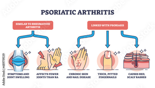 Psoriatic arthritis as chronic dermatological skin condition outline diagram. Labeled educational scheme with illness symptoms like joint swelling, pitted fingernails and rashes vector illustration. photo