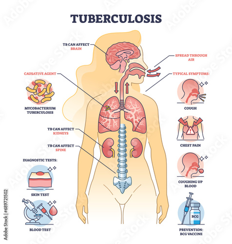 Key aspects of tuberculosis or TB bacterial lung illness outline diagram. Labeled educational scheme with respiratory disease with cough, chest pain and coughing up blood symptoms vector illustration photo