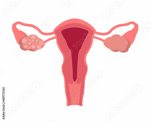 Polycystic ovary syndrome PCOS of women female reproductive system disease vector illustration. photo