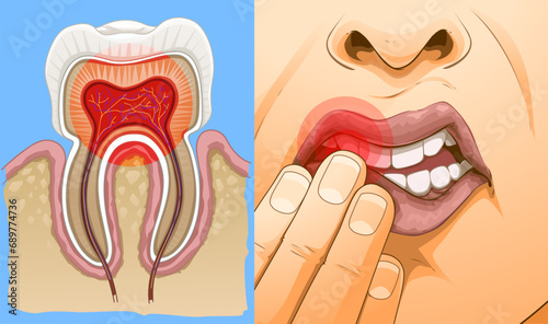 Unhealthy human tooth. Tooth sensitivity triggers. Sharp pain when eating some types of foods. Healthcare illustration, Vector illustration.  photo