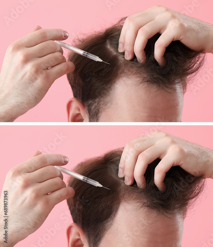 Young man before and after hair loss treatment on pink background, closeup