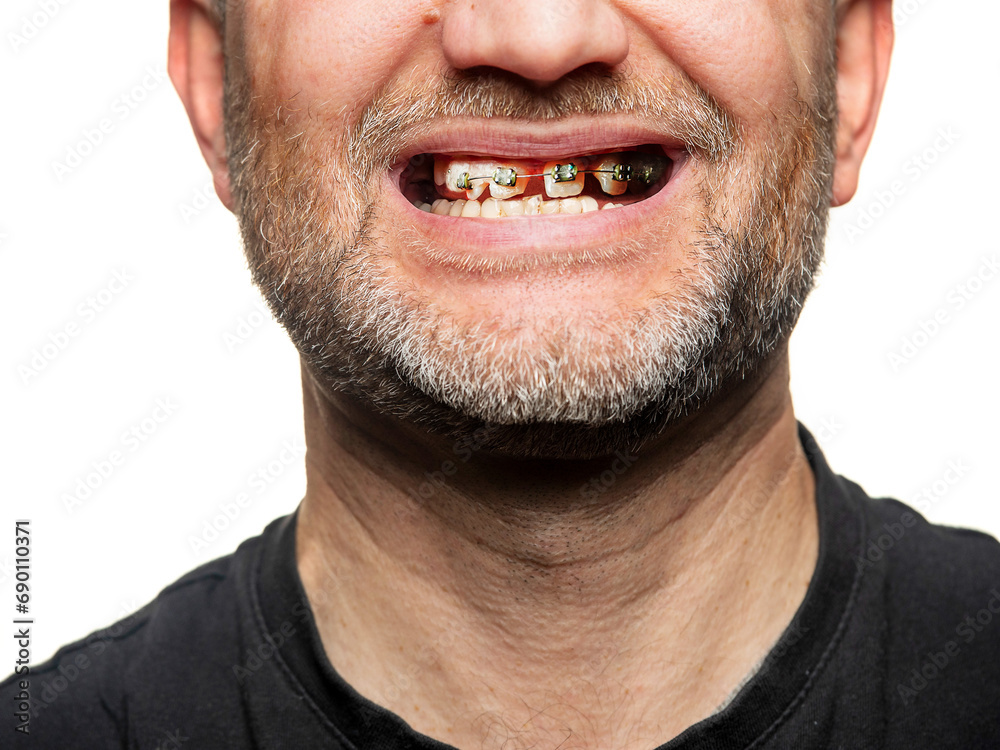 Adult male face close up with open mouth and teeth in bad shape and form with fancy braces. Dental procedure to improve look and functionality. Man with short beard showing his expensive device. Adult male face close up with open mouth and teeth in bad shape and form with fancy braces. Dental procedure to improve look and functionality. Man with short beard showing his expensive device.