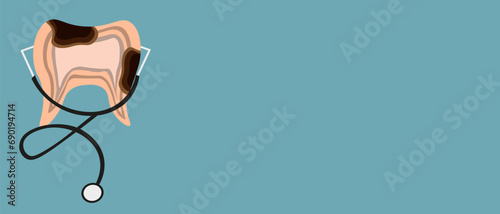 Tooth in trendy cut out paper style with stethoscope. 3d Dental decay Tooth and copy space. Dental care. Vector illustration can used web icon, element, banner and poster for dental clinic.