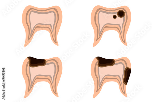 Set of Teeth in trendy cut out paper style isolated white. Collection 3d healthy and diseased teeth. Dental decay. Vector illustration can used web icon, social media poster for dental clinic.