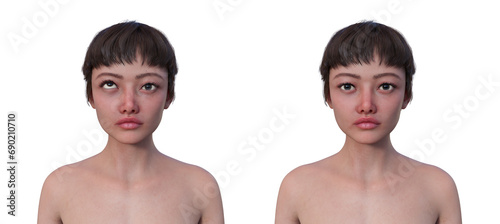 A woman with hypertropia and a healthy person, 3D illustration
