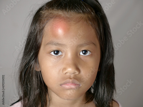 Little Asian girl with swollen bump on her forehead