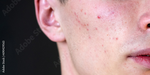 Man with pimples on skin. Acne and pimple on skin. Dermatology, puberty man. Pimples problem. Young Man with Pimple on face. Care skin, Pimples problem. Guy Pimple face, close up. photo