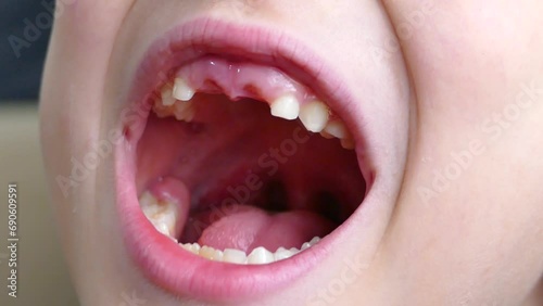 A child's front two primary teeth have fallen out at the age of losing primary teeth,