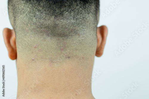 Close-up view of ringworm (tinea) on the head of an Asian man (Dermatitis). Red spots appear, itchy and scaly dandruff on the head. photo