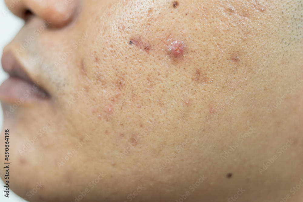 skin problems. problem of inflamed acne on the face. Inflamed acne consists of swelling, redness, and pores that are severely clogged with bacteria, oil, and dead skin cells. skin problems. problem of inflamed acne on the face. Inflamed acne consists of swelling, redness, and pores that are severely clogged with bacteria, oil, and dead skin cells.