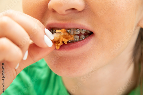 Closeup of woman in dental braces eating chicken drumsticks