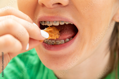Closeup of woman in dental braces eating chicken fillet