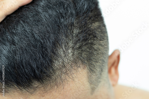 Close Up Young people have problems with hair loss, dryness, dullness, split ends and damage.