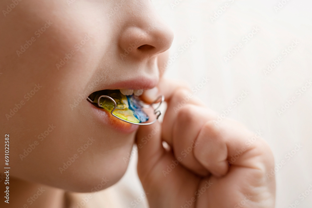 Dental plate Retainer in Child Mouth. Expansion of the Jaw in Child. Happy Girl Kid holding an Orthodontic Plate in Hands. Copy Space. - obrazy, fototapety, plakaty 