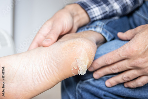 Broken and dry blister skin on the foot