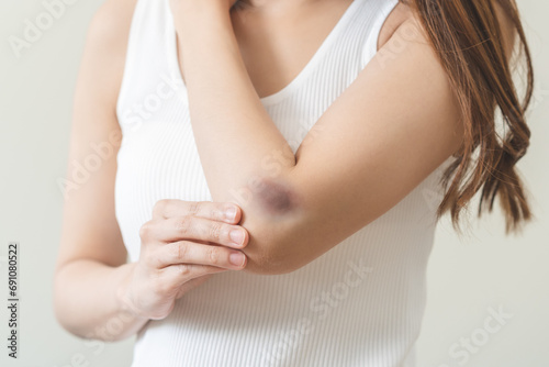 Close up of stain bruise wound on arm, contusion asian young woman, girl an accident fell down stairs, hand on elbow in healing injury by massage hematoma blood. Extravasation blue, purple on skin. © KMPZZZ
