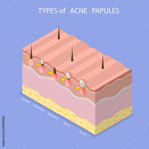 3D Isometric Flat Vector Illustration of Types Of Acne Papules, Skin Problems