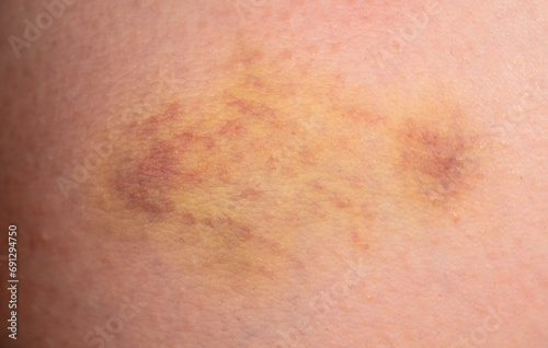 Close-up of a bruise on the skin. Macro