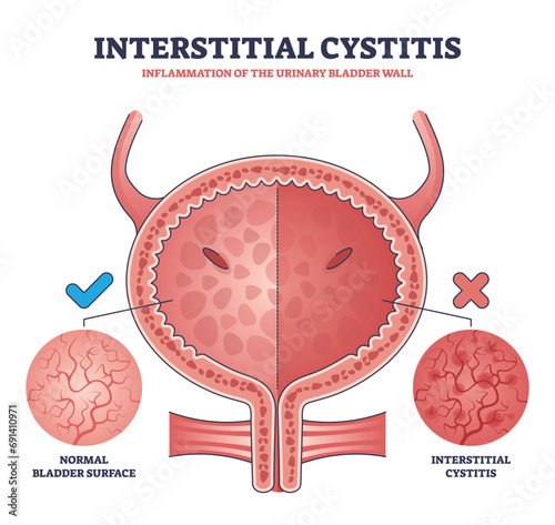 Interstitial cystitis as urinary bladder wall inflammation outline diagram. Labeled educational urology problem and compared healthy bladder surface with inflamed condition vector illustration. photo