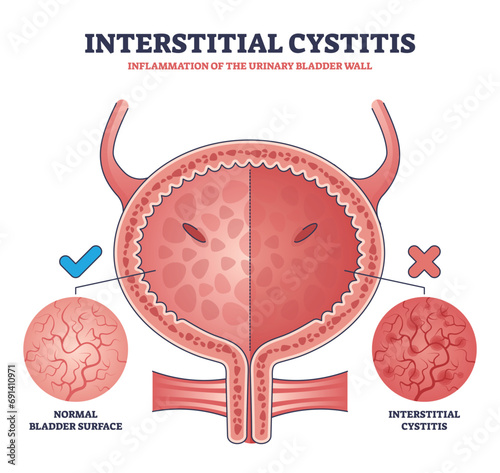 Interstitial cystitis as urinary bladder wall inflammation outline diagram. Labeled educational urology problem and compared healthy bladder surface with inflamed condition vector illustration.