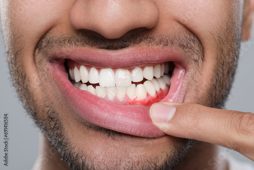 Принти на полотні Man showing inflamed gum on grey background, closeup