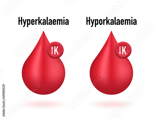 Hyperkalaemia, high plasma potassium level and Hypokalaemia, low plasma potassium level. Potassium K excess and deficit electrolyte disorders, blood test. Vector illustration