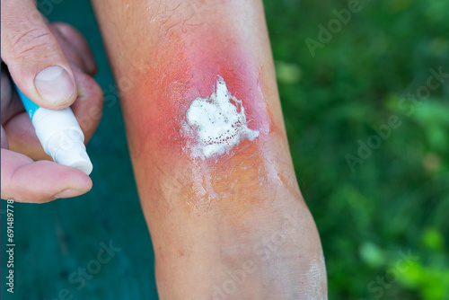 This is a photograph of a man applying antiseptic ointment to a red rash on his arm. photo