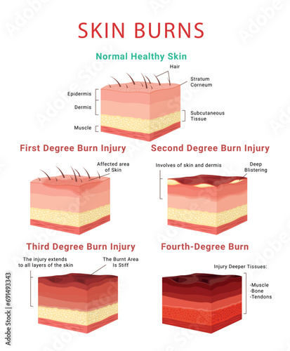 Skin burn classification infographic medical educational scheme poster isometric vector illustration photo