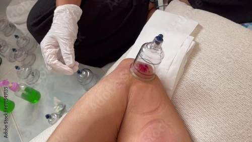 Close up on doctor with latex gloves applying wet cupping therapy with suction gun on patient elbow and blood coming out of skin. Alternative medicine, ancient Chinese pain healing method concepts photo