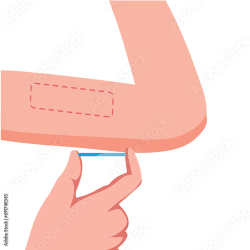 woman contraceptive implant prevention