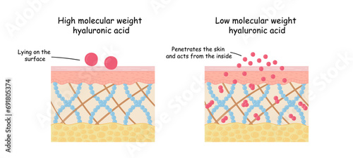 Low molecular weight hyaluronic acid, skin anatomy. illustration of facial cosmetic procedures