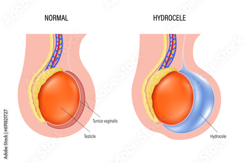 Hydrocele is a swelling of the scrotum. Fluid accumulates in cavity that surrounds testicles. Testicular disease. male reproductive system.