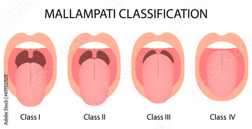 Mallampati Classification score. Oral airway intubation. Medical procedure vector illustration isolated on white background photo