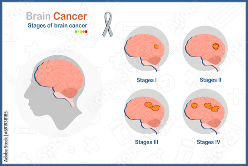 Brain cancer. Medical vector illustration in flat style of the four stages of brain cancer.isolated on white background.health care and medical concepts.
