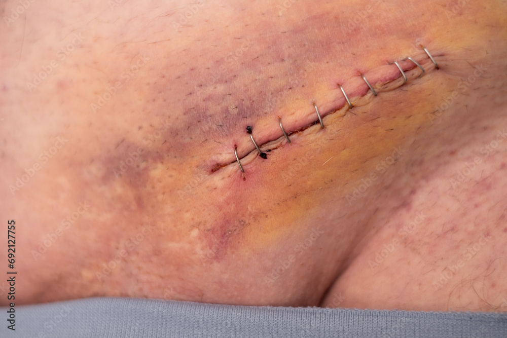 Nine staples to the groin scar on the body of an elderly gentleman after an inguinal hernia operation - obrazy, fototapety, plakaty 