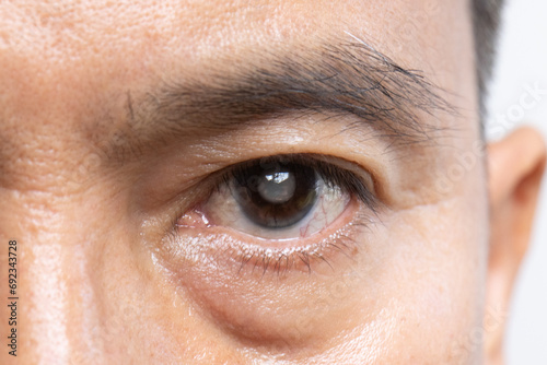 фотографія Senior man has cataracts