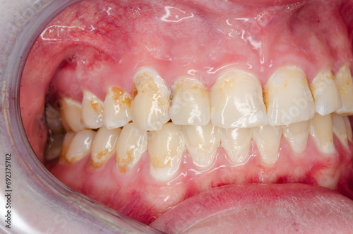Plaque and tooth decay of a young adult