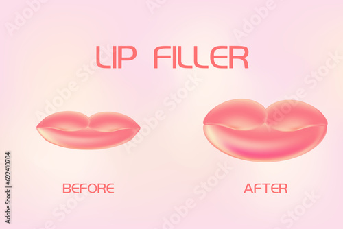Lip filler before, after background. Lips injection of hyaluronic acid. Beauty clinic concept. Vector illustration